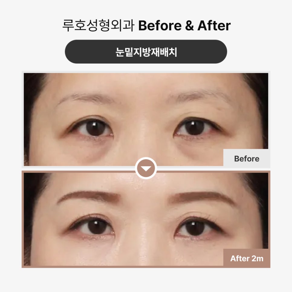 눈밑볼록, 신사역 눈밑지방재배치 받은 후기 관련 이미지 1