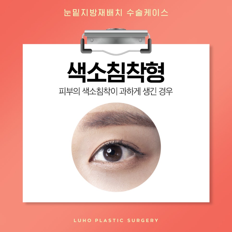 눈밑지방재배치 다크서클 개선에 효과적 관련 이미지 2