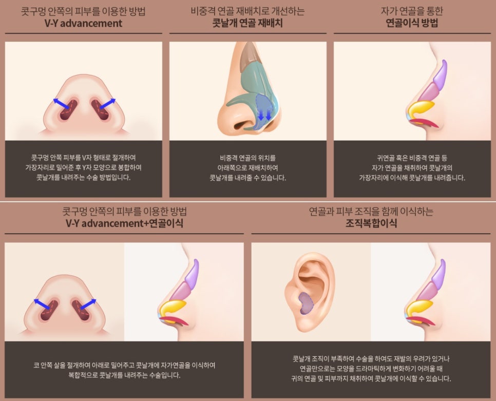 돼지코처럼 보이는 코, 신사역 콧날개내리기로 해결하기 관련 이미지 6