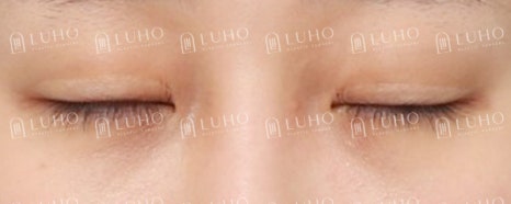 과거 수술 후 졸려 보이던 눈매를 교정한 눈재수술 관련 이미지 7