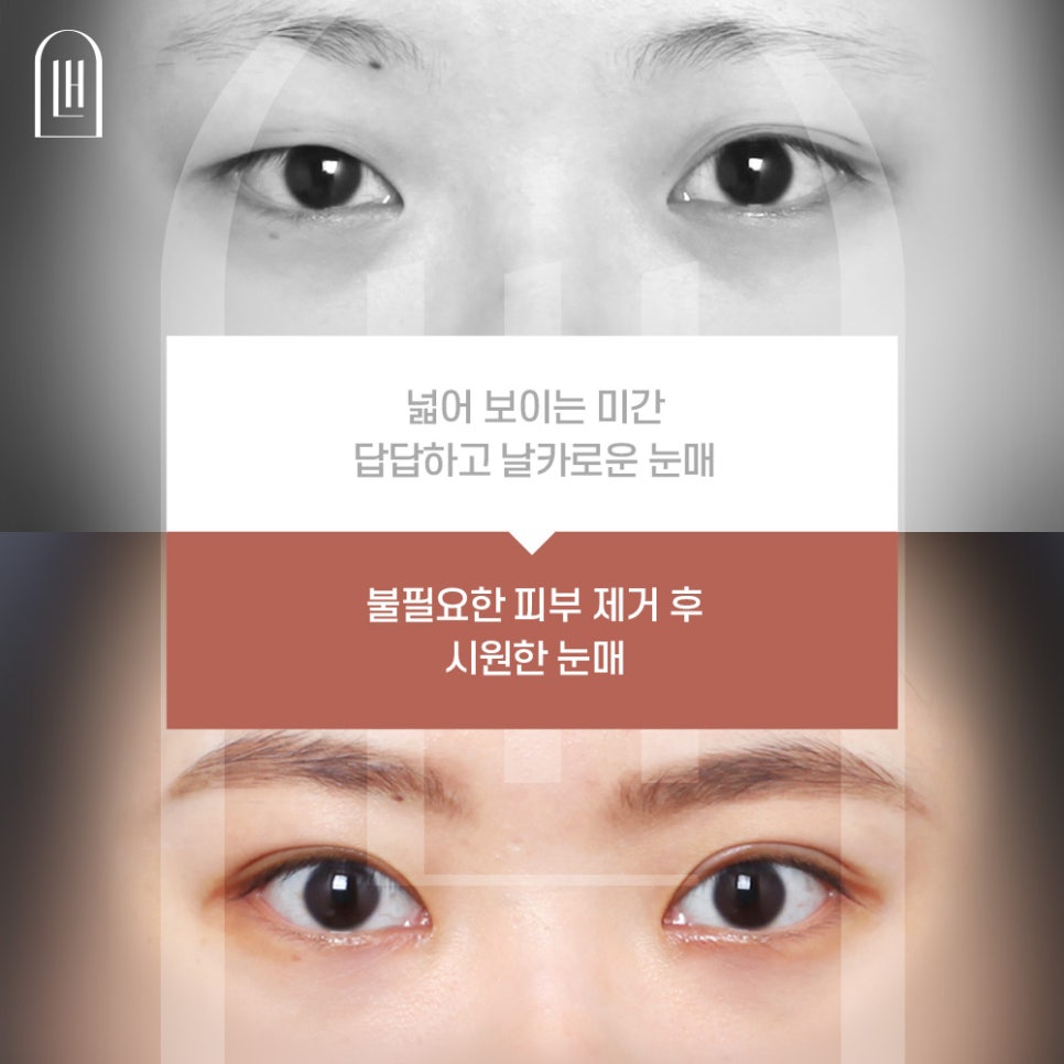 Inner Corner Epicanthoplasty for a Brighter Eye Shape image 3