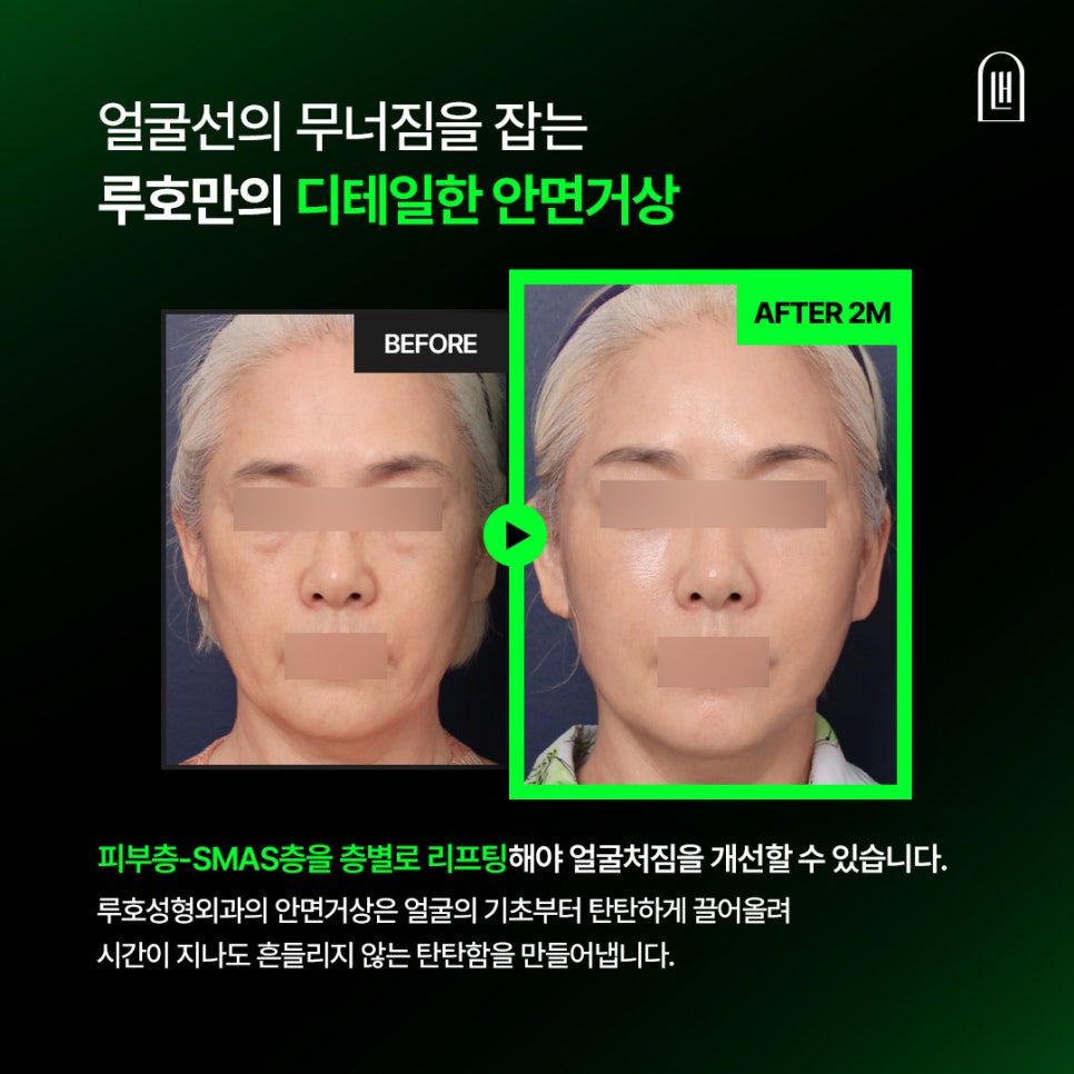 Before and After Facial Lift Surgery to Correct Collapsed Facial Structure image 1
