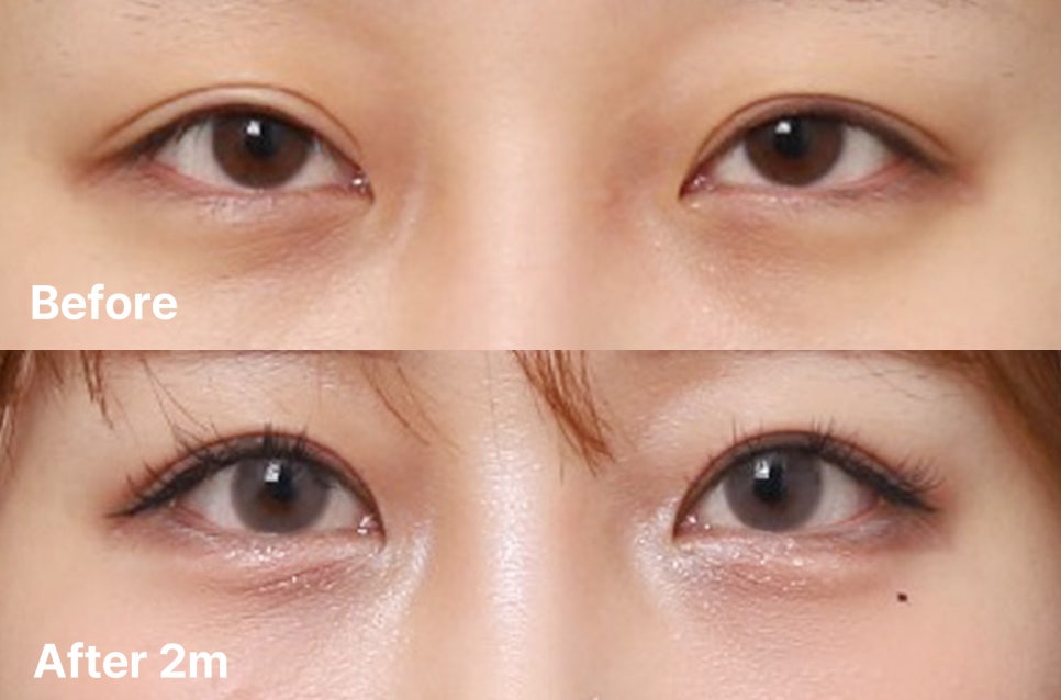 과거 수술 후 졸려 보이던 눈매를 교정한 눈재수술 관련 이미지 1