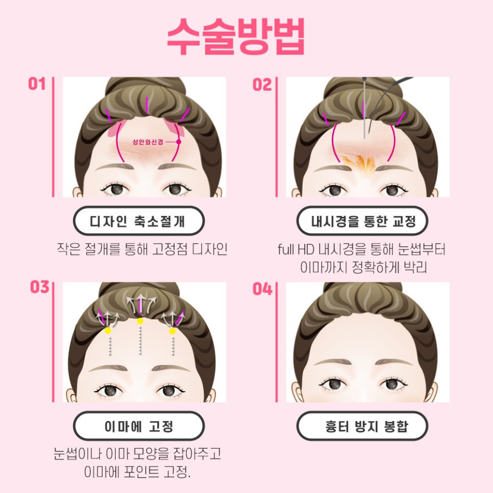 Endoscopic Forehead Lift image 4