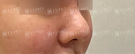 Redesigning a Bulbous Nose After 9 Years: Revision Rhinoplasty image 9