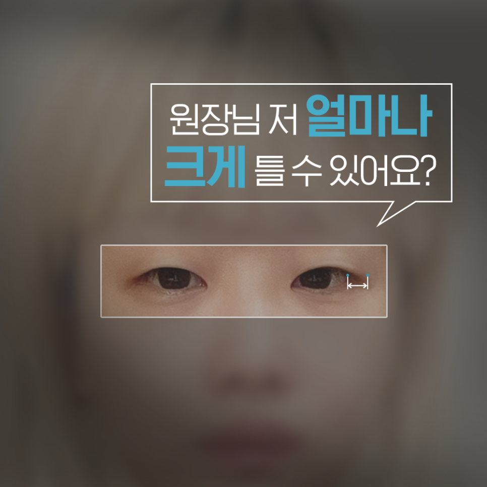 [루호성형외과] 작은 눈도 종류가 있다? 이런 분들은 꼭 트임 눈성형 하세요 관련 이미지 5
