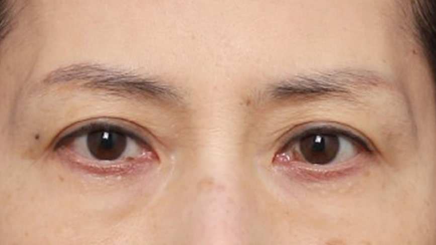 Real Patient Review: Eye-Corner Thread Lifting for a More Open, Defined Look image 4