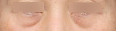 Sinsa Station Lower Blepharoplasty That Changed Heavy-Looking Under-Eyes image 3
