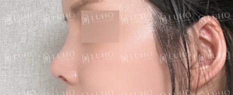 휜코를 교정하여 균형을 되찾은 코재수술 사례 관련 이미지 8