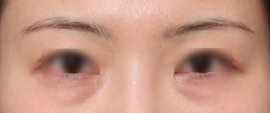 눈 밑 꺼짐을 개선하고 환하게 변한 신사역 눈밑지 전후 비교 관련 이미지 2