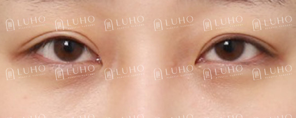 과거 수술 후 졸려 보이던 눈매를 교정한 눈재수술 관련 이미지 2