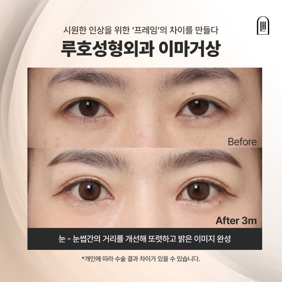 밝고 시원한 인상으로 바뀐 신사역 이마거상 후기 관련 이미지 1