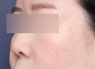 Rhinoplasty for a Hump Nose at Sinsa Station: A Review of the Change to a Smooth Line image 2