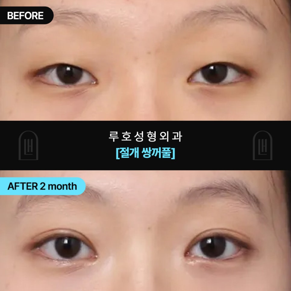 두꺼운 눈꺼풀, 신사역 절개쌍꺼풀로 개선한 후기 관련 이미지 1