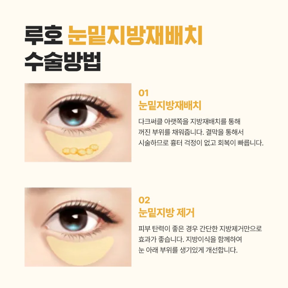 눈밑볼록, 신사역 눈밑지방재배치 받은 후기 관련 이미지 5