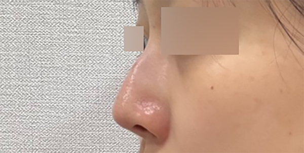 From the Curve of the Nasal Bridge to the Tip: Refining the Line with Hump Nose Surgery image 3