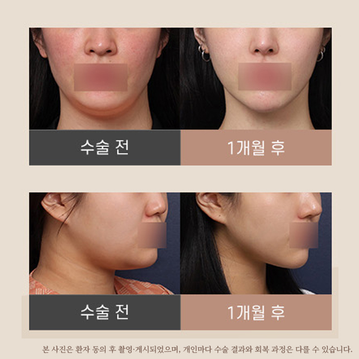 신사역 성형외과 미니거상 전후 비교 후기 관련 이미지 1