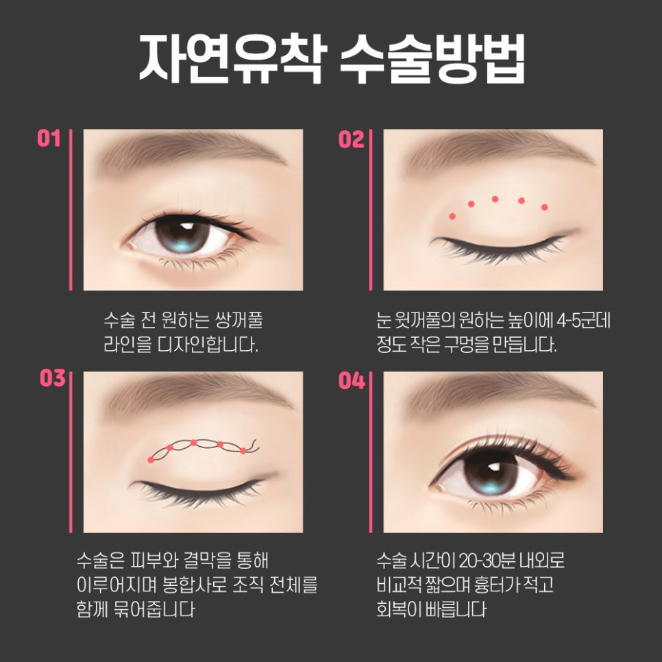 자연유착쌍꺼풀수술,내가 원하는 눈으로 루호에서 관련 이미지 6