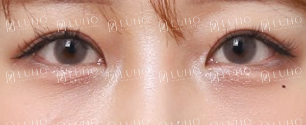 과거 수술 후 졸려 보이던 눈매를 교정한 눈재수술 관련 이미지 9