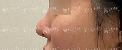 Redesigning a Bulbous Nose After 9 Years: Revision Rhinoplasty image 5