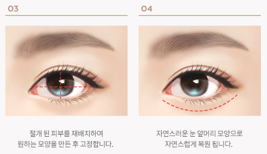 Scar after epicanthoplasty? Can it be improved with epicanthoplasty revision near Sinsa Station image 7