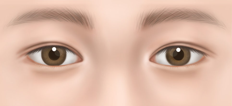 Scar after epicanthoplasty? Can it be improved with epicanthoplasty revision near Sinsa Station image 3