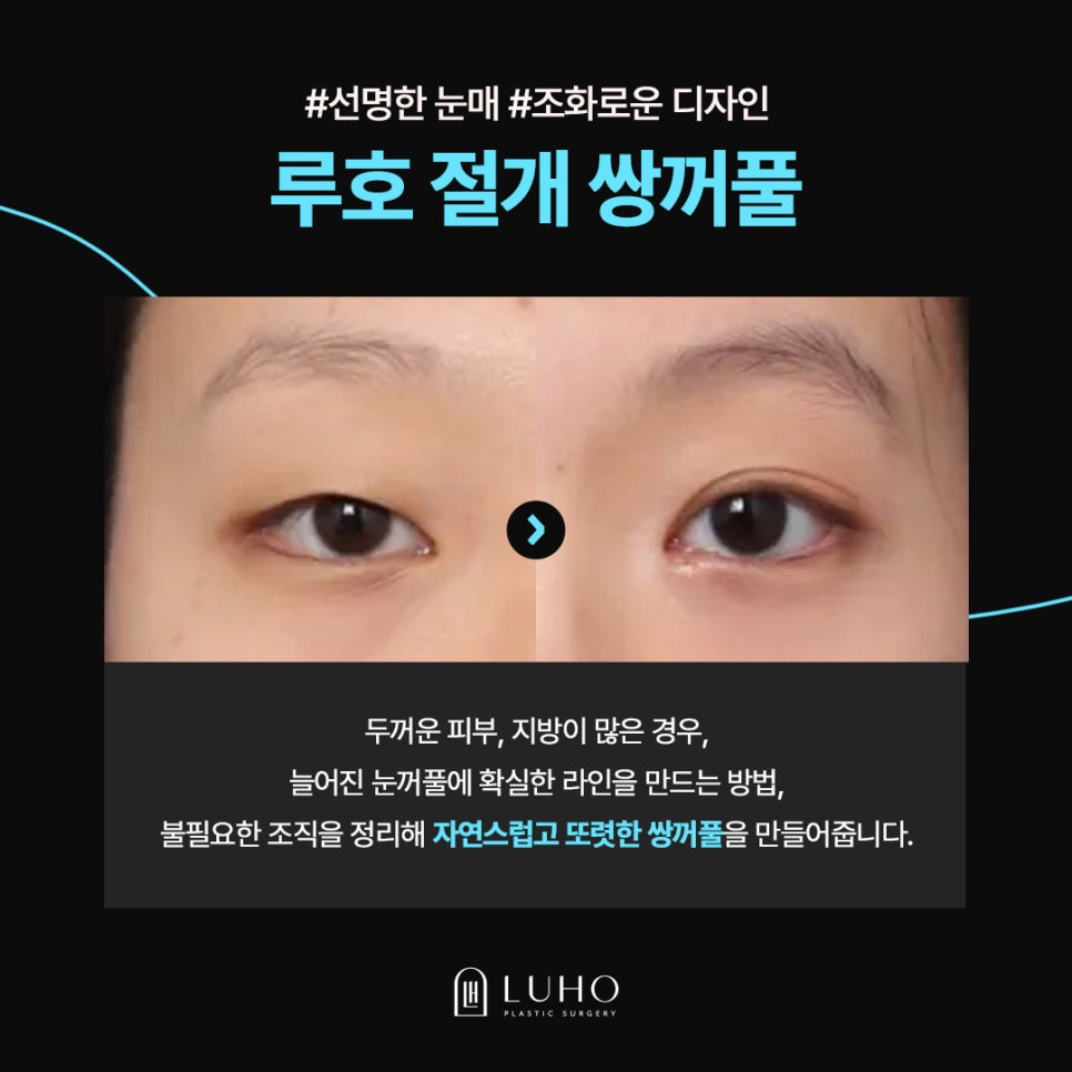 두꺼운 눈꺼풀, 신사역 절개쌍꺼풀로 개선한 후기 관련 이미지 3