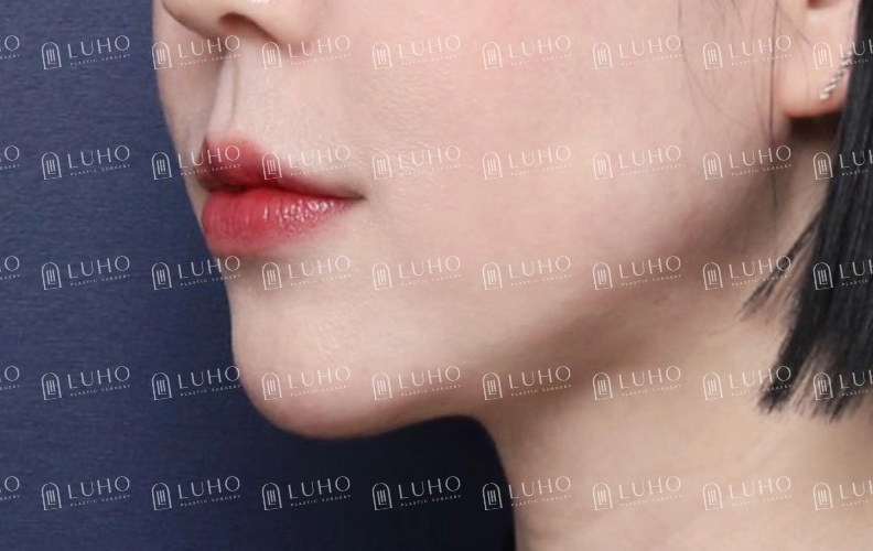다이어트해도 안 빠지는 턱살, 이중턱 근육 묶기로 달라진 후기 관련 이미지 7