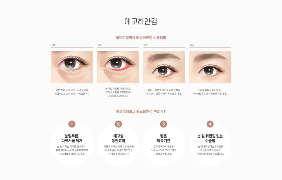 눈 수술법의 종류와 회복기간 #2 관련 이미지 2