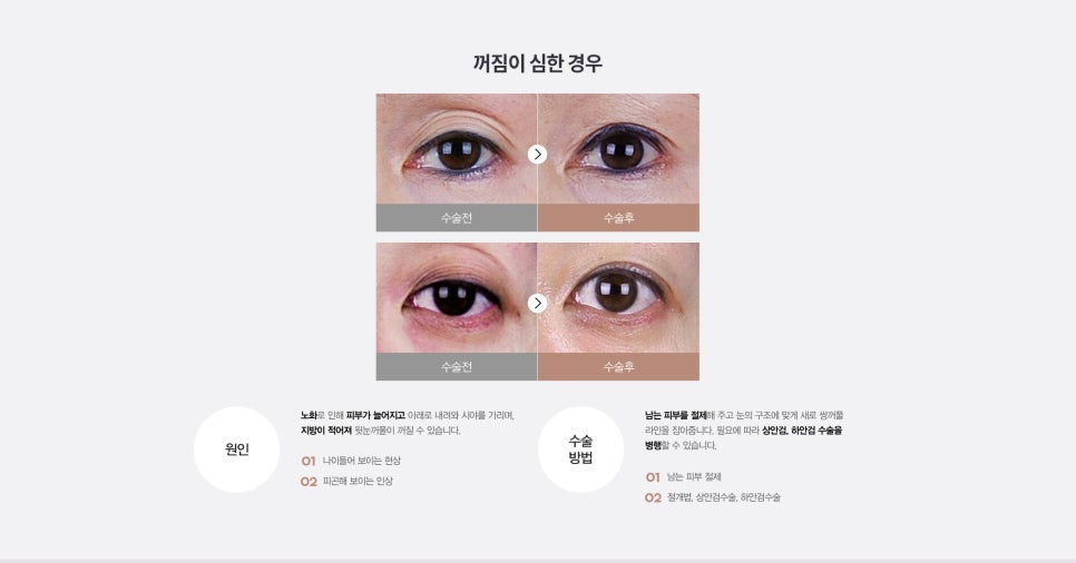 눈 수술법의 종류와 회복기간 #2 관련 이미지 13