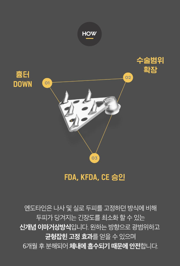 ［루호성형외과］🧓🏻중년부터 청년까지👨🏻 다~받는 엔도타인 이마거상 관련 이미지 11