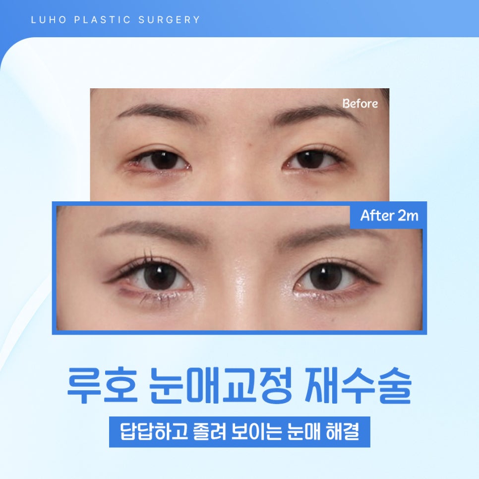 신사역 눈매교정 재수술, 안검하수 개선한 후기 관련 이미지 1