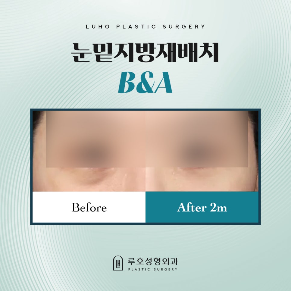 Sinsa Station Dark Circle Lower Eyelid Fat Repositioning: The Shadow Created by the Boundary Between the Under-Eye and Upper Cheek image 1