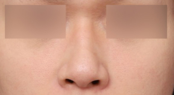 Before and After: Results That Changed with a Type-Specific Approach to Male Rhinoplasty at Sinsa Station image 2