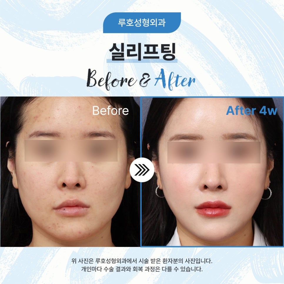 Before and After: Refining a Sagging Lower Face with Thread Lifting at Sinsa Station image 1