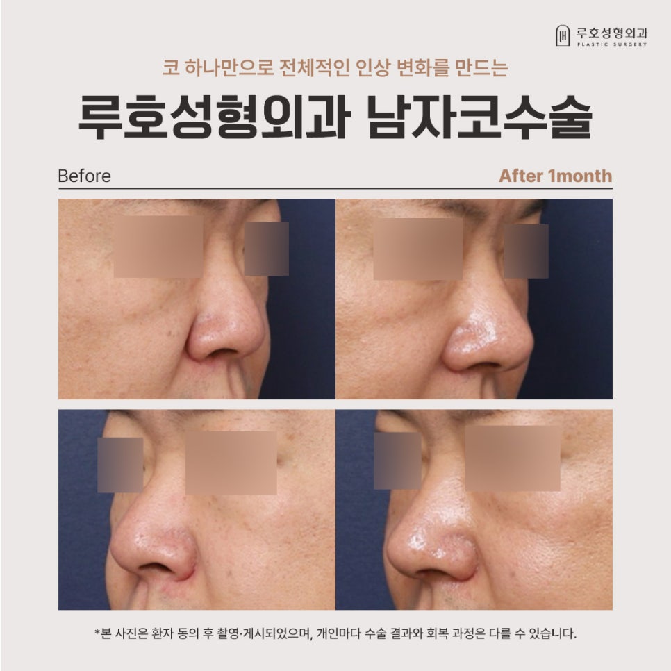 높이보다 조화를 만든 신사역 남자코수술 병원 후기 관련 이미지 1