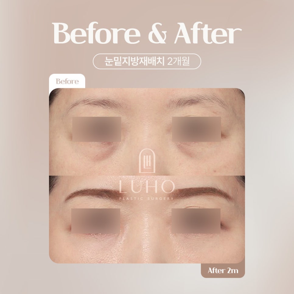 루호성형외과 눈밑지방재배치 관련 이미지 4