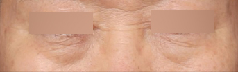 The Effects of Lower Blepharoplasty That Transformed Sagging Under-Eye Skin image 3
