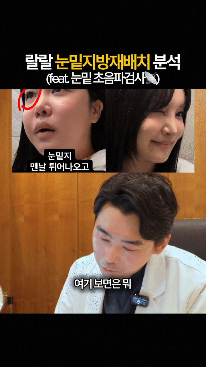 Sinsa Station Under-Eye Fat Repositioning Clinic: Dark Circles + Review of Improvement for Uneven Under-Eyes image 3