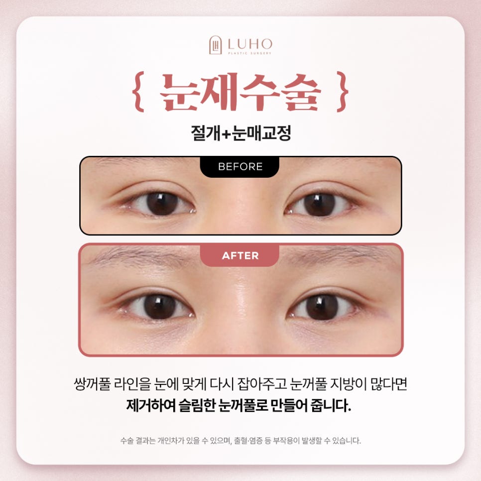 소세지 눈, 비대칭 라인 해결하려면? 관련 이미지 3