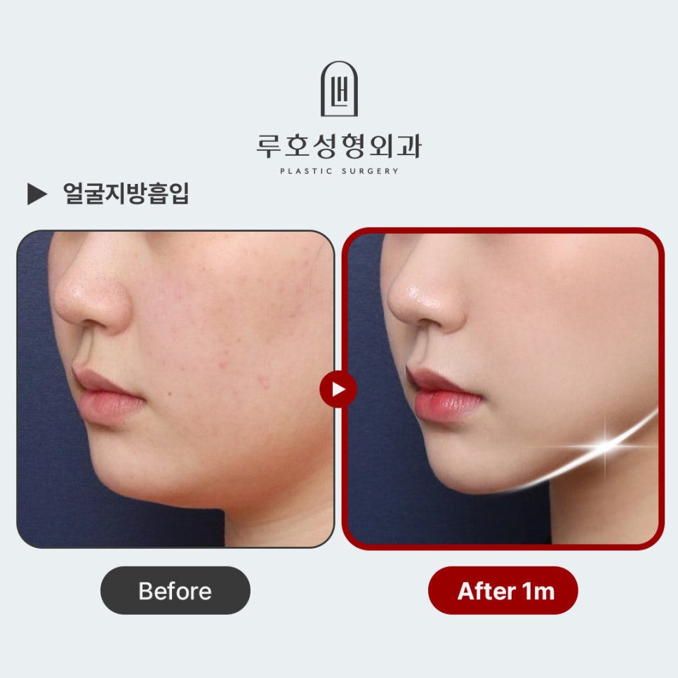 턱라인을 슬림하게 만든 얼굴지방흡입 후기 관련 이미지 1