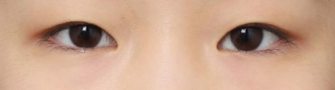Review of Lateral and Lower Canthoplasty for Opening Up a Tight-Looking Eye Shape image 2