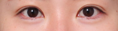 A Case of Eye Surgery Near Sinsa Station: Changed to a Natural and Defined Look image 5