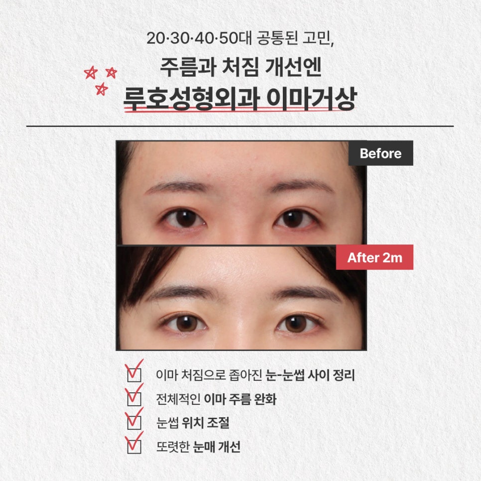 A Case of Forehead Lift Surgery That Gave a Heavy Appearance More Definition image 2