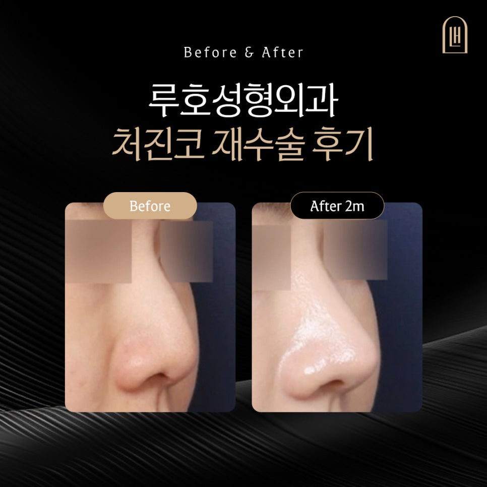 A Review of Reconstructing a Drooping Nose into an Elegant One Through Revision Surgery Near Sinsa Station image 1