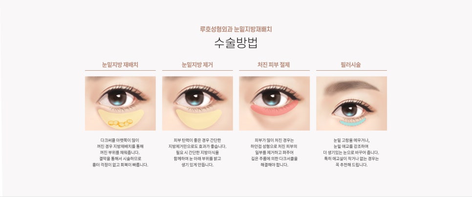 눈 수술법의 종류와 회복기간 #2 관련 이미지 4