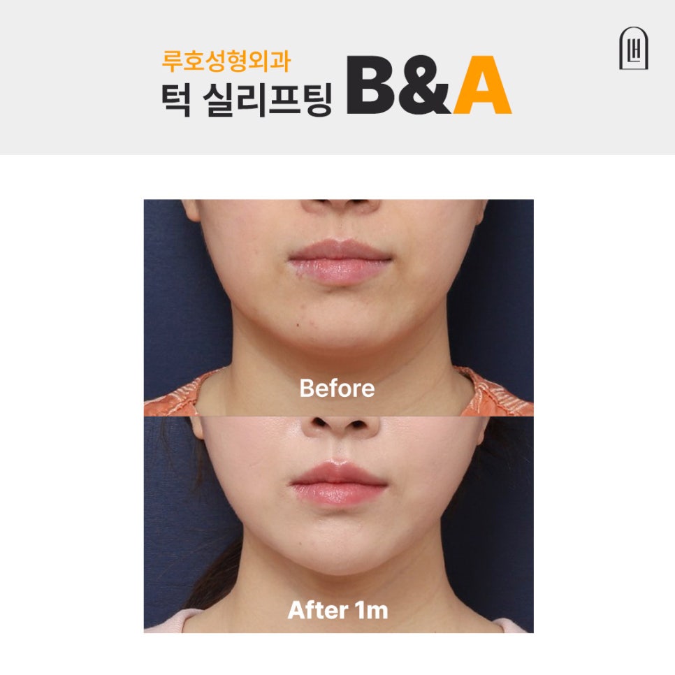 흩어진 균형과 라인을 동시에 잡은 신사역 성형외과 실리프팅 전후 관련 이미지 1