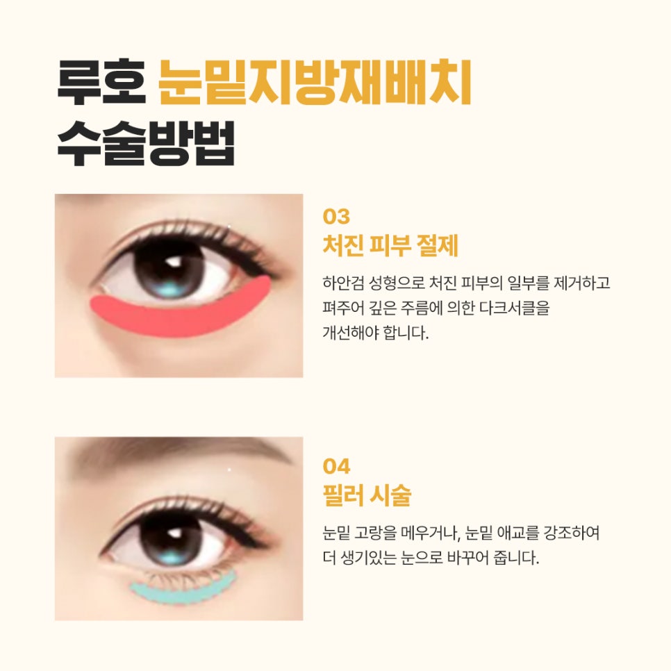 눈밑볼록, 신사역 눈밑지방재배치 받은 후기 관련 이미지 6