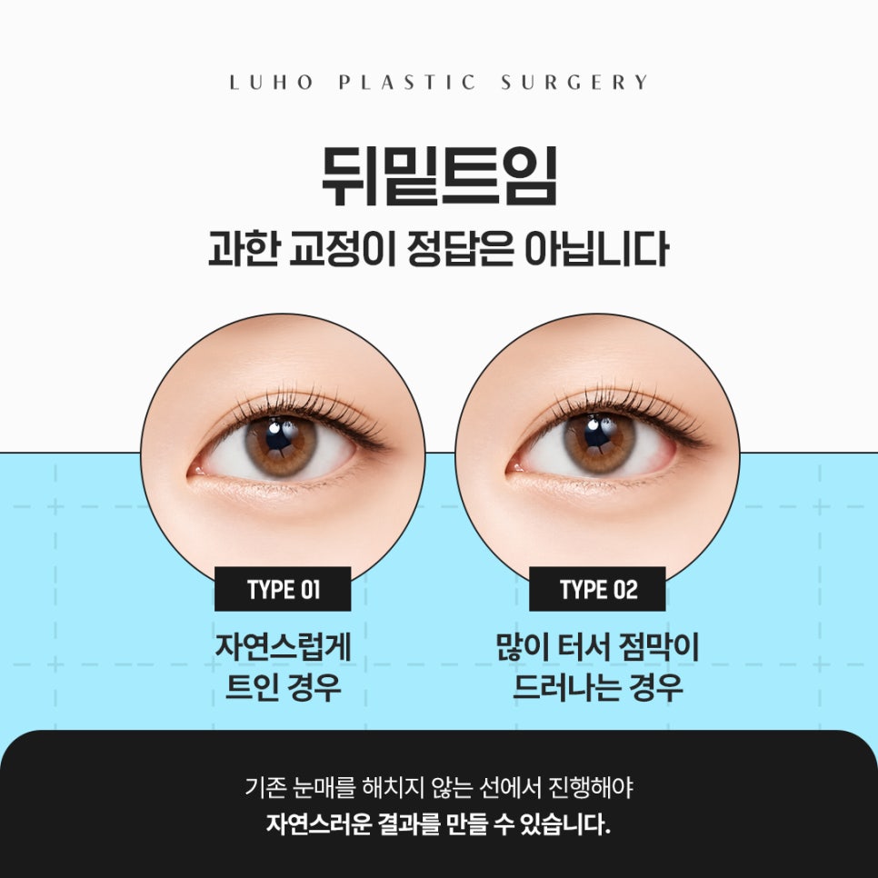 Review of Lateral and Lower Canthoplasty for Opening Up a Tight-Looking Eye Shape image 4