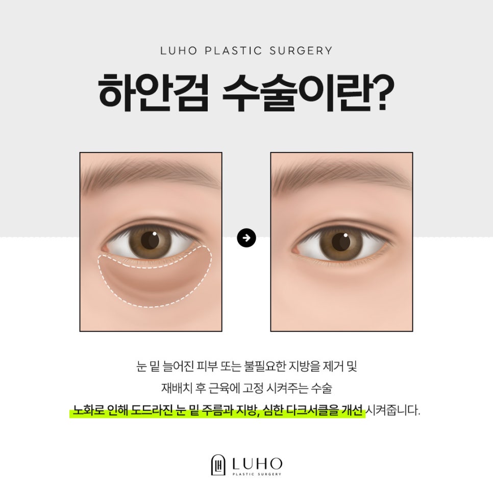 Curious About a Real Case of Lower Blepharoplasty for Under-Eye Sagging at Sinsa Station? image 3